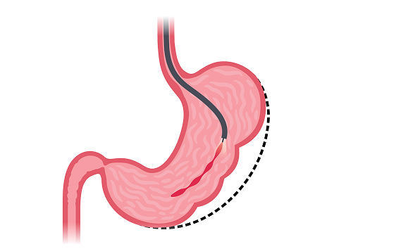 Endoscopic Sleeve Gastroplasty in Bahrain procedure
