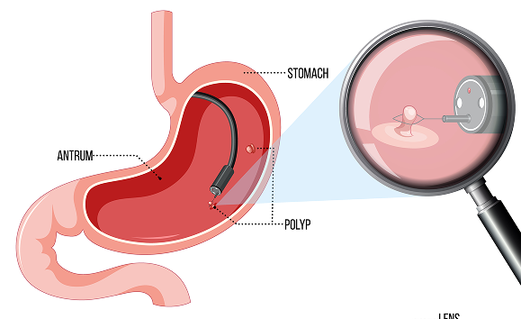 Image showing Peroral Endoscopic Myotomy in Bahrain