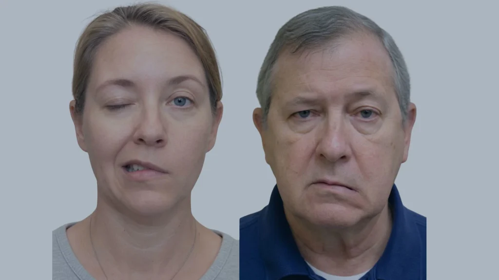 a person with bells palsy and another person with stroke
