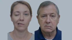 a person with bells palsy and another person with stroke