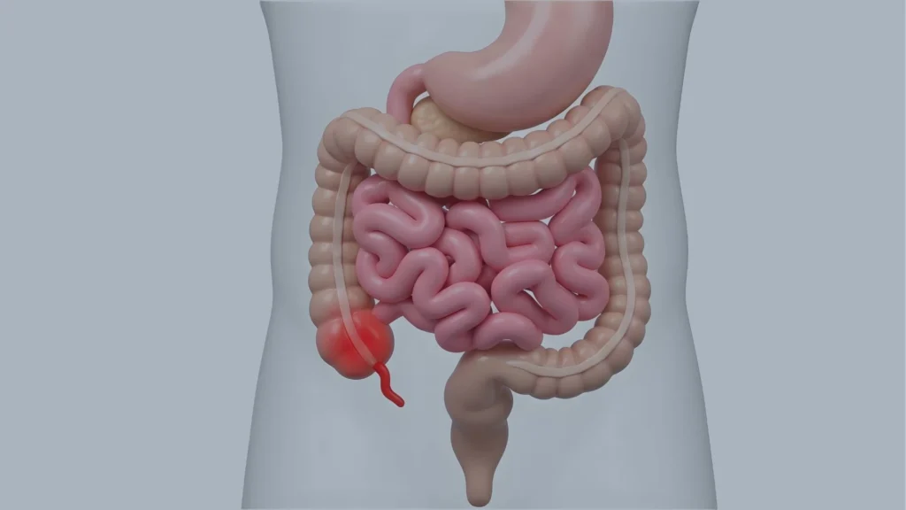 4 stages of appendicitis