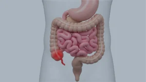 4 stages of appendicitis