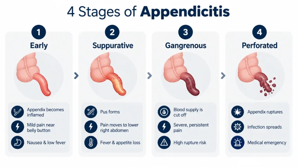 4 stages of appendicitis