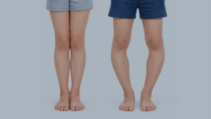 Bow Legged and normal leg comparison